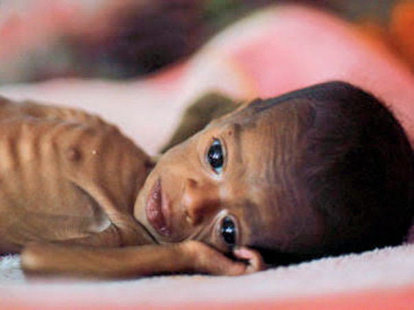 Nutrition for 300 Malnourished children