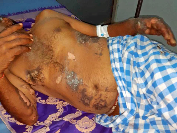 Help Rajanna Recover From Electrocution