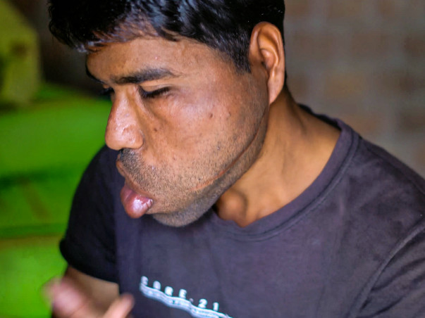 Rare Disease Has Caused His Face To Swell Like Abnormally