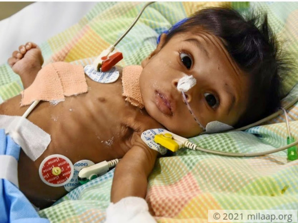 Help 9-month-old Elisha Who Has Lost 90% Of Her Small Intestine