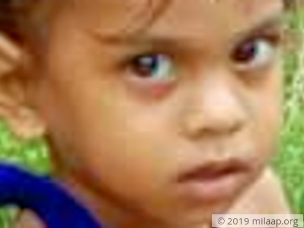 Baby Botta Hema Latha Acute myeloid leukaemia M3