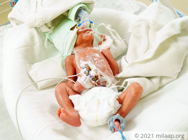 Twin babies of meenu needs your help to survive