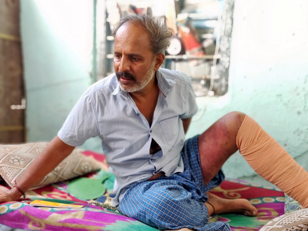 After a Bus Ran Over Man's Leg, His Family Was Brought To The Streets