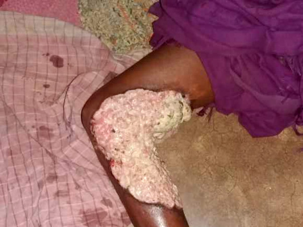 Help Shankar Fight Skin Cancer