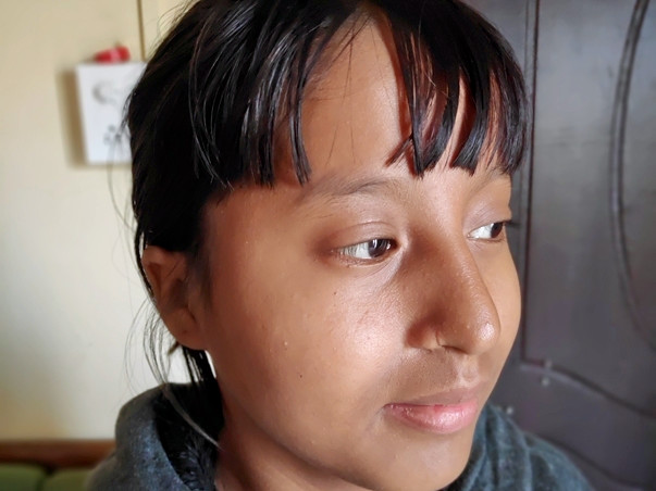 Help Junmoni For Her Nose Surgery