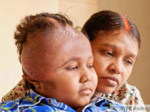 A Deadly Tumor Has Disfigured This Young Boy's Face, Needs Help