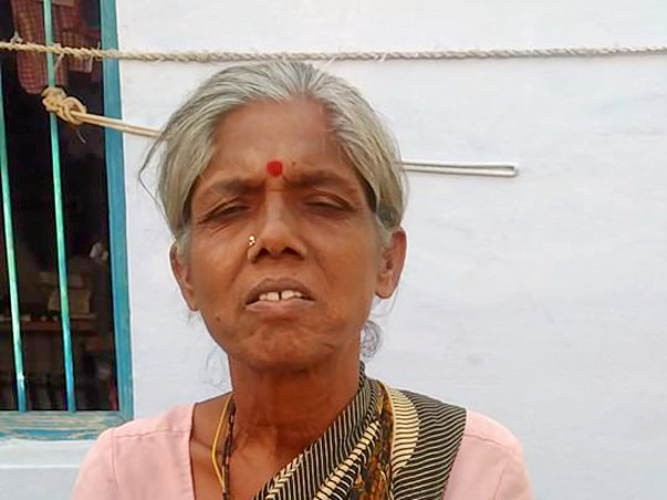 Help My Mother for ileal conduit urinary diversion Operation