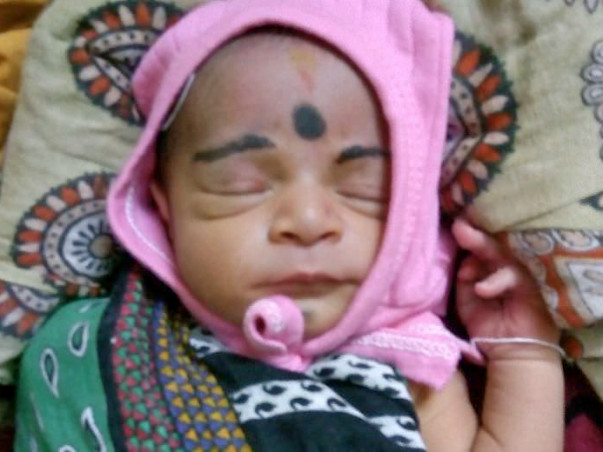 Baby sonali Heart surgery