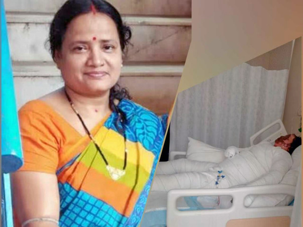 Help My Mother Recover From Severe Burns