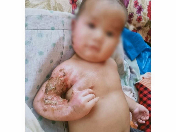 Support Baby Of Sumarlang Dkhar Recover From Severe Burns