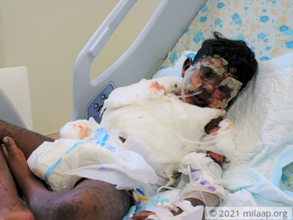 Skin Disease Has Ravaged This Boy's Face And Body, Needs Urgent Help