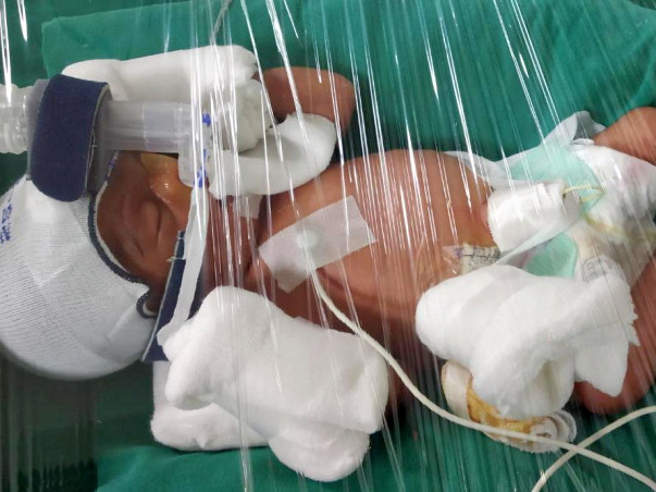 Open Heart Surgery. Twin Babies are born Preterm , Please Help