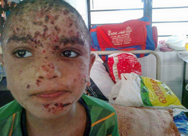 Help Thanseeh for Bone Marrow transplantation