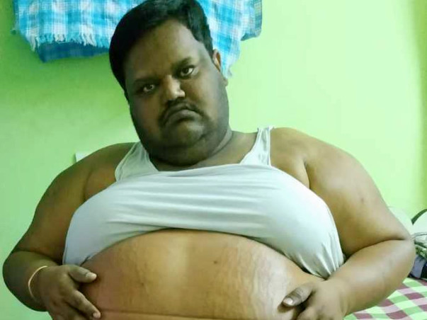 Help Naveen Goud With Morbid Obesity Stomach Filled With Water