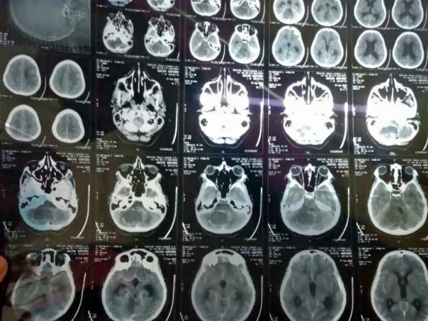 This 14 years old needs your urgent support in fighting Brain tumor