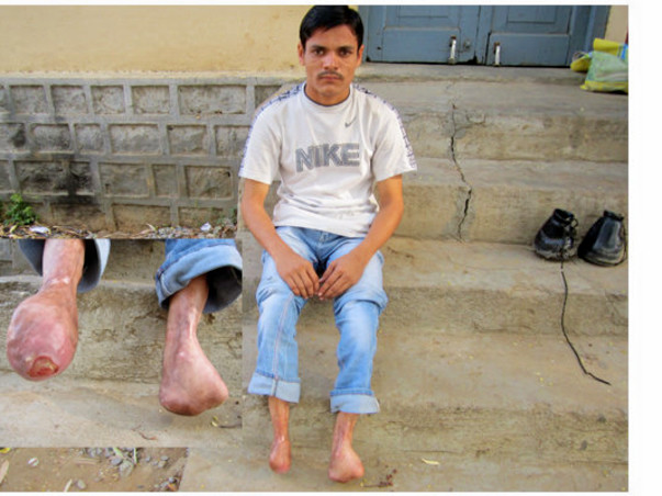 Help Feetless Yadagiri Buy Artificial Limbs