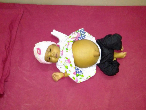 Help Baby Tahoora Begum Undergo A Liver Transplant