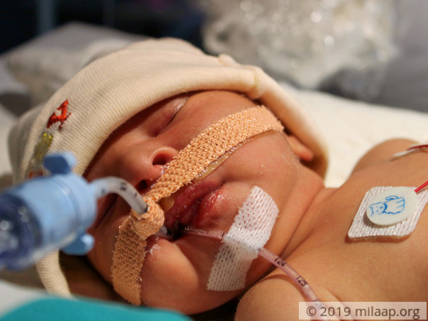 Baby of Rayeesa needs your help to survive