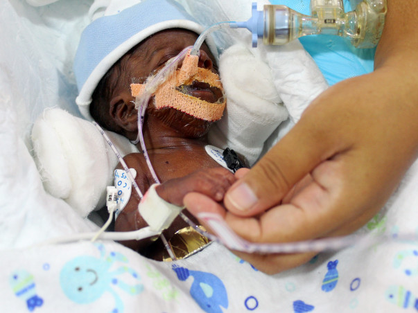 Nurse's 20-day-old Baby Is Now Bleeding Into His Lungs And Needs Help