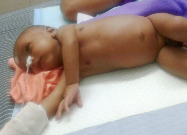 Save Little 2-Month's Old Baby From Hirschsprung Disease
