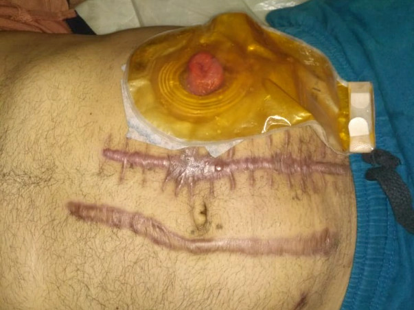 Pleading Help To Save Mr.gani Ailing From Cancer