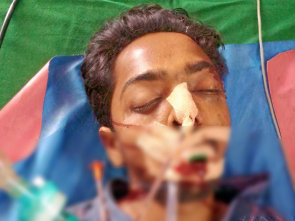 Help My Friend Recover from Temporal EDH with Femur Fracture