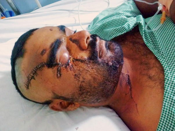 Help My Friend Undergo MaxilloFacial surgery and Rightleg operation