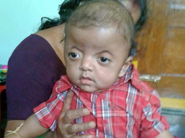 Help Vibhu Get Treated For Apert Syndrome