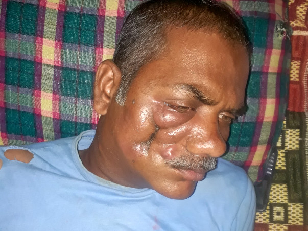 Help Kalusingh Fight Oral Cancer