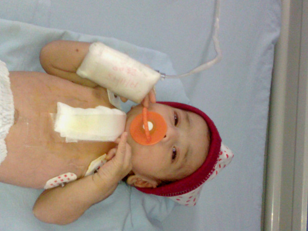 Help for an open heart surgery costs for a 4 days old baby