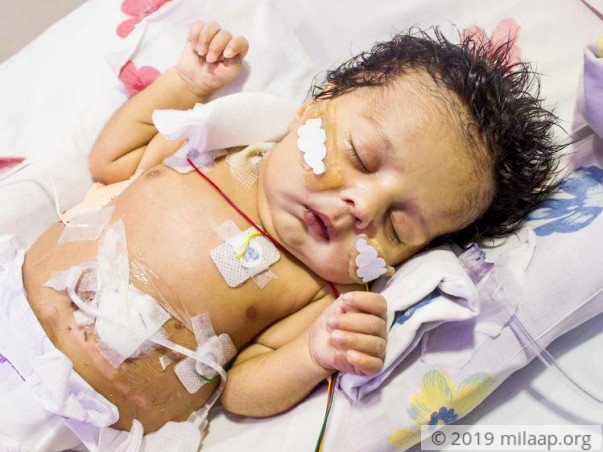 This Baby Boy Born Without Food Pipe Will Die Without Treatment