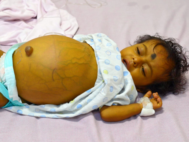 My 9 month old son needs a Liver Transplant as soon as possible