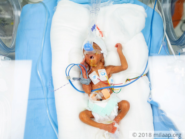 Help this first-time parents save their premature baby boy