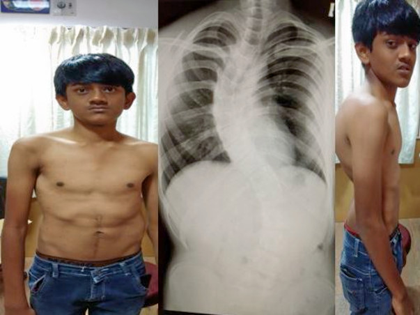 Help 18 Year Old Engineering Student Undergo Spinal Deformity Surgery