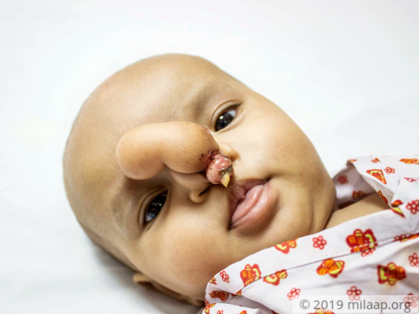 5month old shanti has a rare condition which doesn't let her breathe
