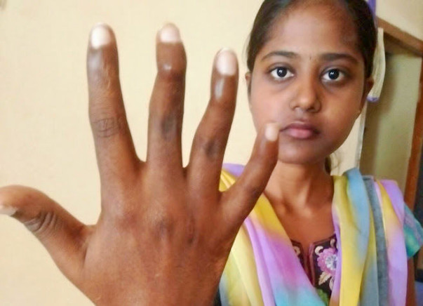 Help Pallavi With Her Hand Surgery To Write Again