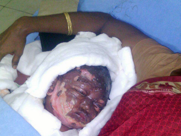Help this 16 month old baby girl who is suffered serious burns.