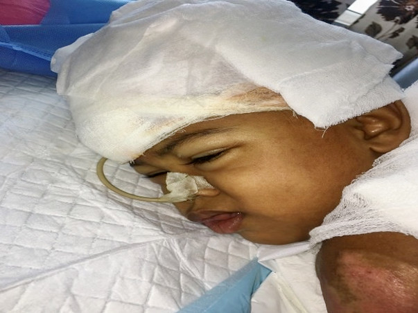 Fire Accident - This baby 50% of body deeply burnt below her chest. .