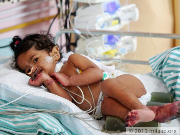 10-Month-Old Baby Girl Will Lose Her Limbs And Life To Gangrene