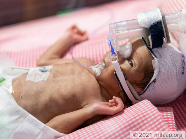 Help Baby of Mamatha to fight disease