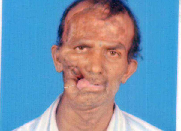 Help this 48-year-old fisherman with facial deformity