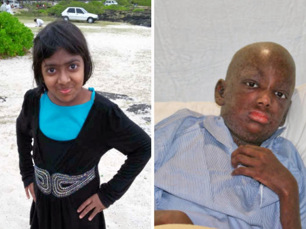 This 13-year-old Has No Friends Or A Childhood Because Of Lupus