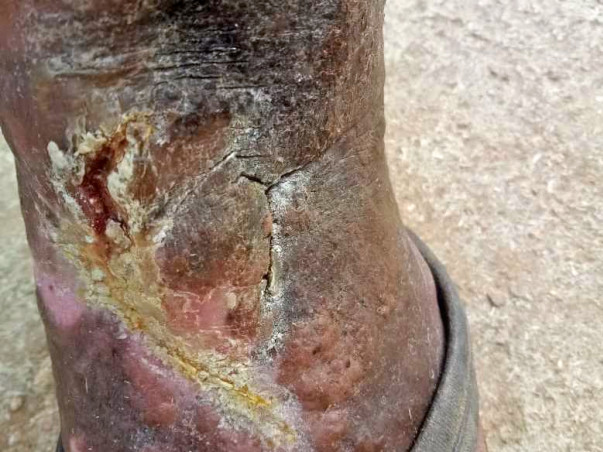 Support Satyanarayana Recover From Ulcer Wound In Left Leg