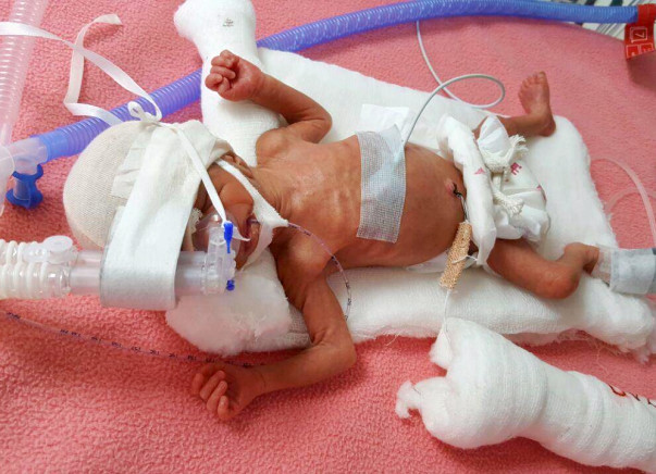Help a new born fight a battle of life.