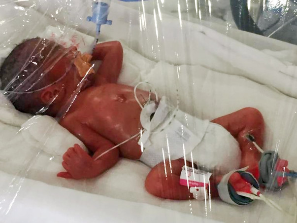 Help Premature Baby Born At 27week 750gms Operated For Gut Perforation
