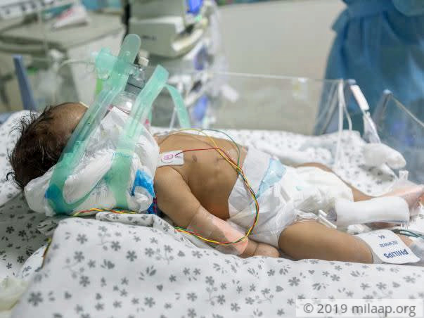 Help this 1-month-old boy who is fighting for his life