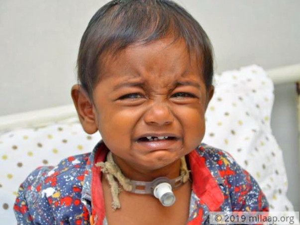 1-year-old Joel Has A Blocked Windpipe & He Needs A Surgery To Breathe