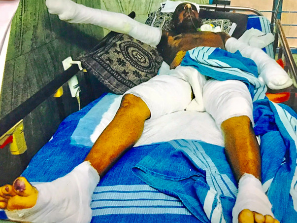Help Prem Kumar To Recover From Skin Flame Burn
