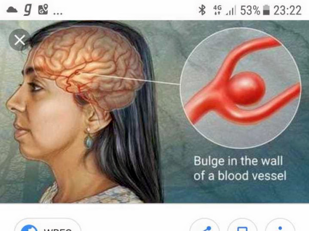 Help my mother recover from Brain Aneurysm