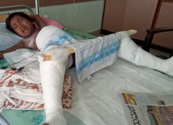 Help For My Daughter's Dislocated Hip Surgery
